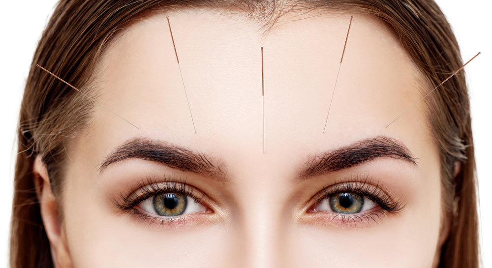 5 Reasons Why the Summer Is the Perfect Time to Start Your Acupuncture Sessions w