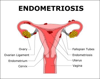 endometrosi