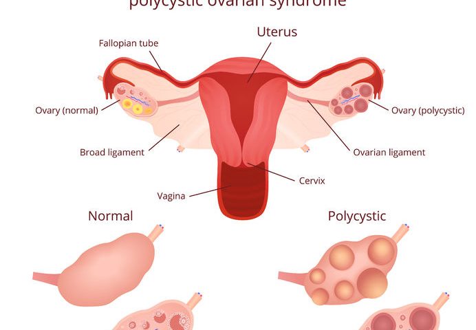 polycystic ovary syndrome PCOS56801820 M