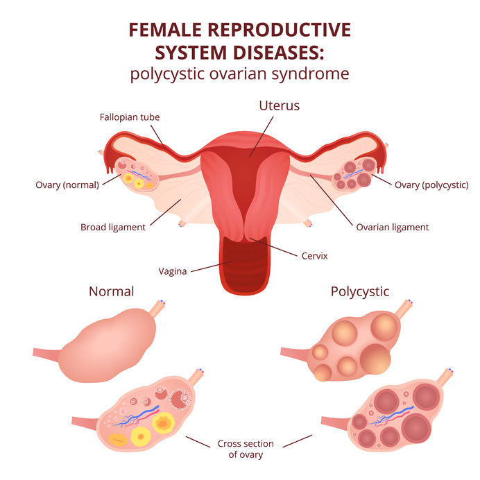 polycystic ovary syndrome PCOS56801820 M